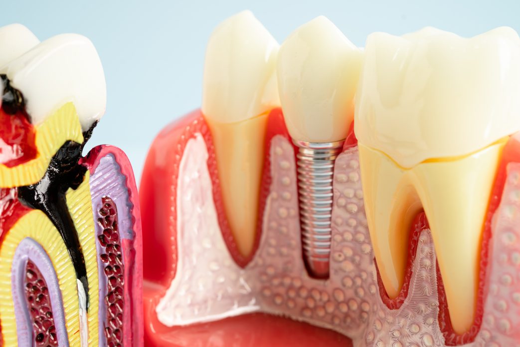 Dental implant, artificial tooth roots into jaw, root canal of dental treatment, gum disease, teeth model for dentist .